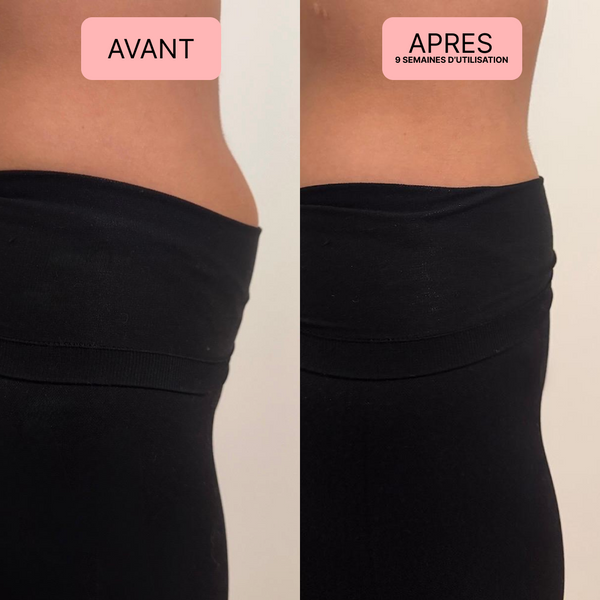 Distension abdominale